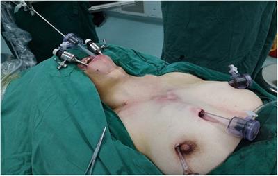 Endoscopic lateral neck dissection via the breast and transoral approaches for papillary thyroid carcinoma: A preliminary report